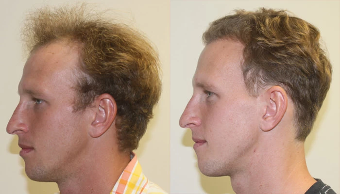 Patient p129 hair transplant before and after left view