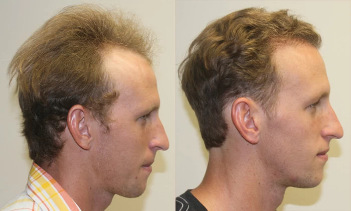 Patient p129 hair transplant before and after right view