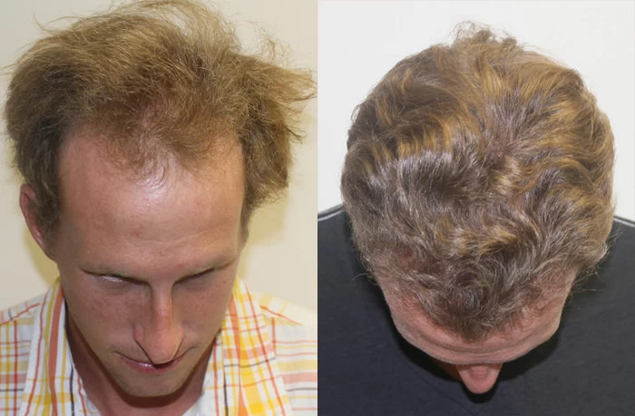 Patient p129 hair transplant before and after tilt view