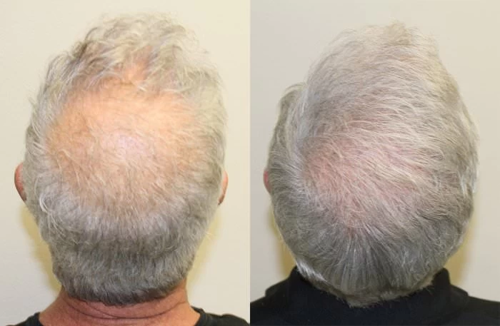 Patient p132 hair transplant before and after crown view