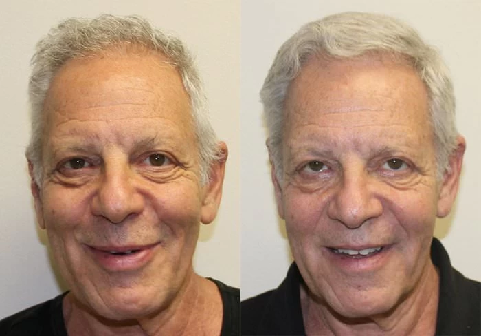 Bill Hair Transplant Before and After