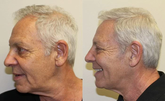 Patient p132 hair transplant before and after left view