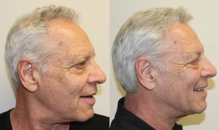Patient p132 hair transplant before and after right view