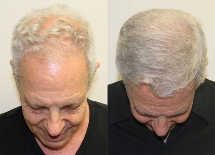 Patient p132 hair transplant before and after tilt view