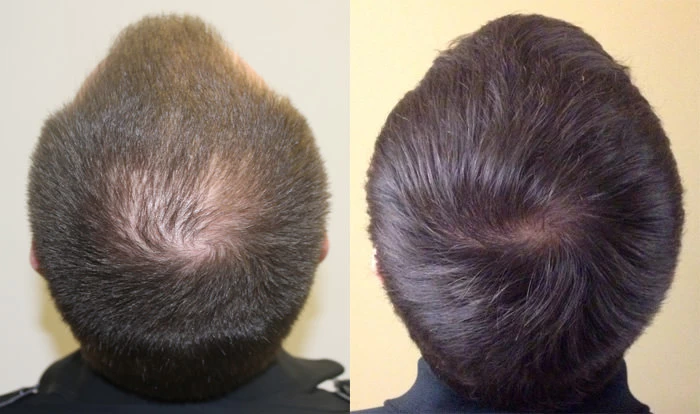 Patient p135 hair transplant before and after crown view