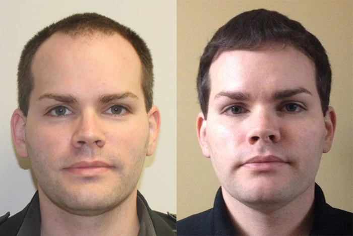 Paul Hair Transplant Before and After