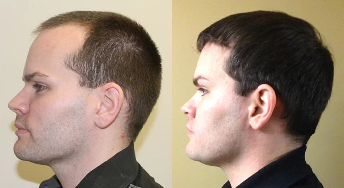 Patient p135 hair transplant before and after left view