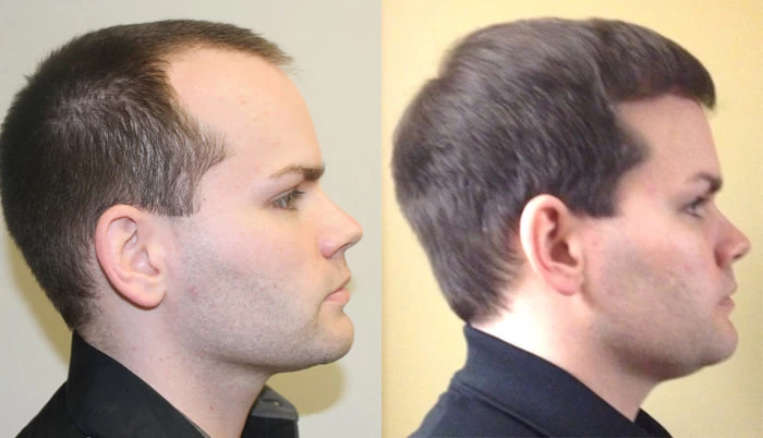 Patient p135 hair transplant before and after right view
