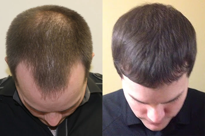 Patient p135 hair transplant before and after tilt view