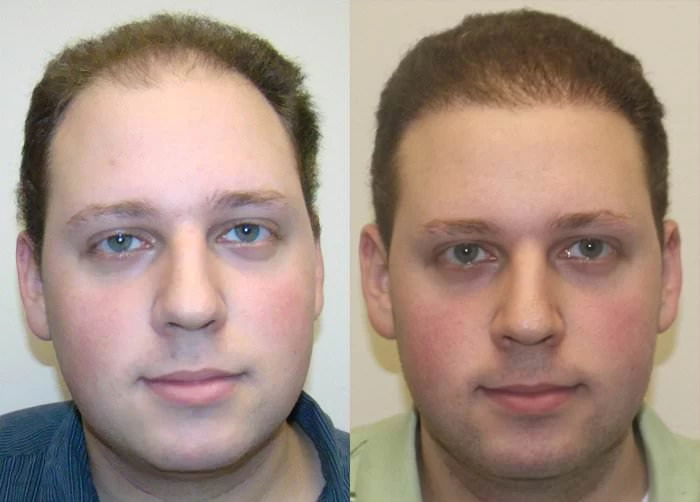 Evan Hair Transplant Before and After