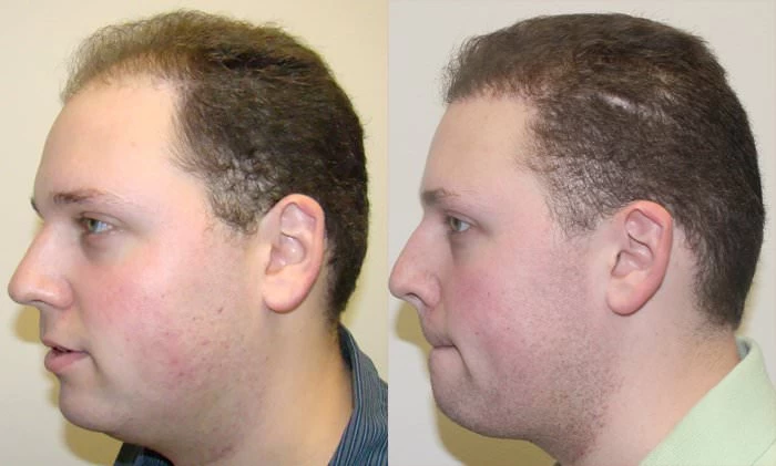 Patient p136 hair transplant before and after left view