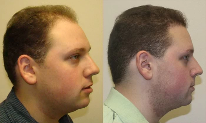 Patient p136 hair transplant before and after right view