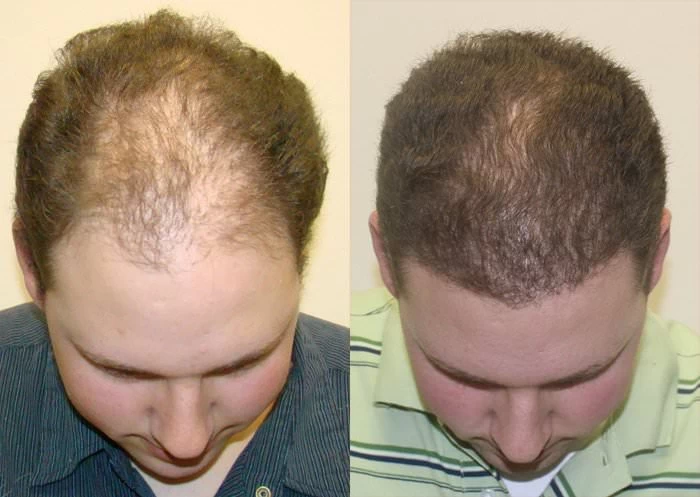 Patient p136 hair transplant before and after tilt view