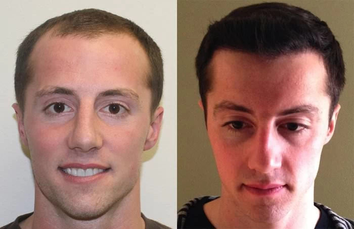 Ryan Hair Transplant Before and After