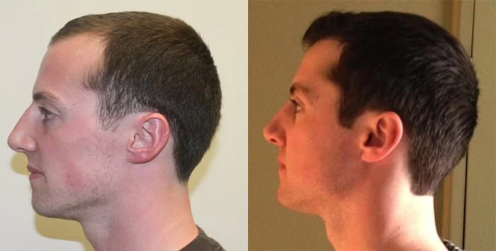 Patient p137 hair transplant before and after left view
