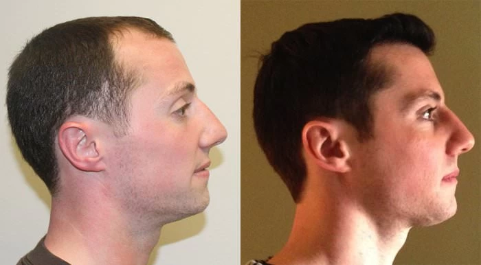 Patient p137 hair transplant before and after right view
