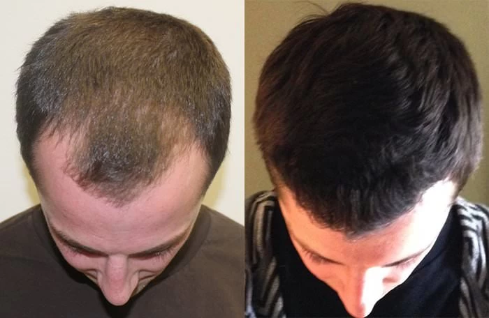 Patient p137 hair transplant before and after tilt view