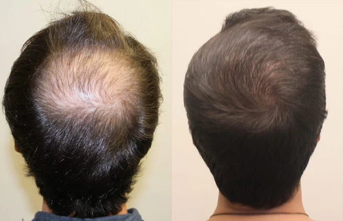 Patient p139 hair transplant before and after crown view