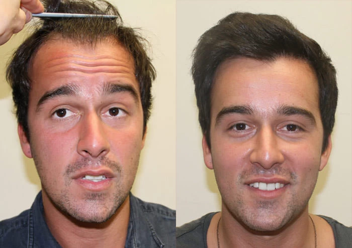 Mo Hair Transplant Before and After