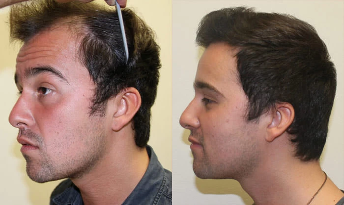 Patient p139 hair transplant before and after left view