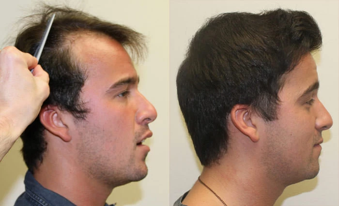 Patient p139 hair transplant before and after right view