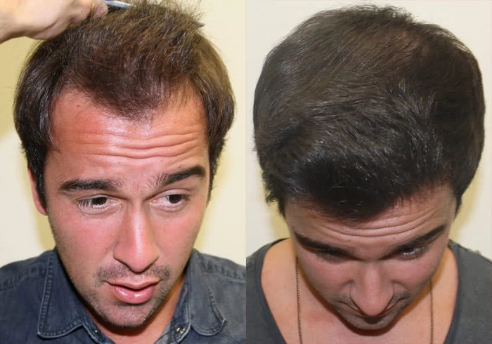Patient p139 hair transplant before and after tilt view