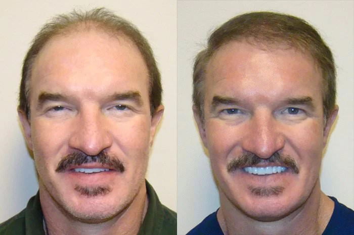 Scott Hair Transplant Before and After