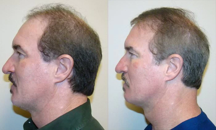 Patient p145 hair transplant before and after left view