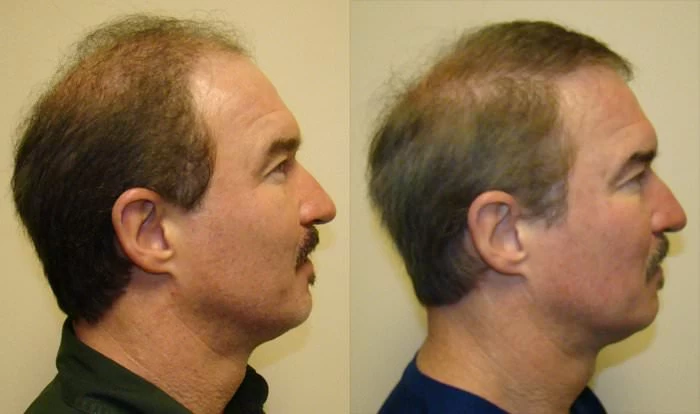 Patient p145 hair transplant before and after right view