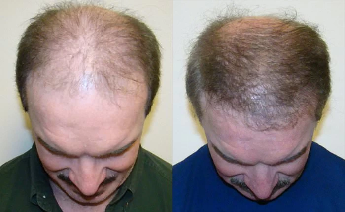 Patient p145 hair transplant before and after tilt view