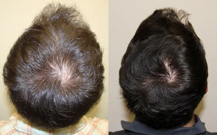 Patient p14 hair transplant before and after crown view