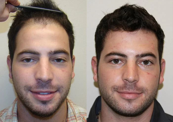 Joey Hair Transplant Before and After