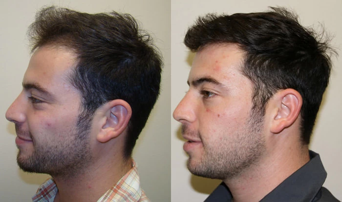 Patient p14 hair transplant before and after left view