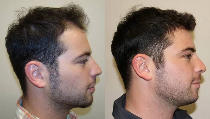 Patient p14 hair transplant before and after right view