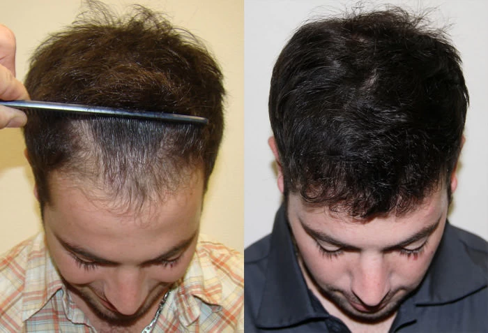 Patient p14 hair transplant before and after tilt view