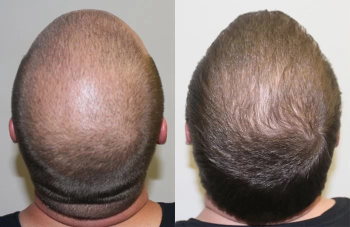 Patient p150 hair transplant before and after crown view