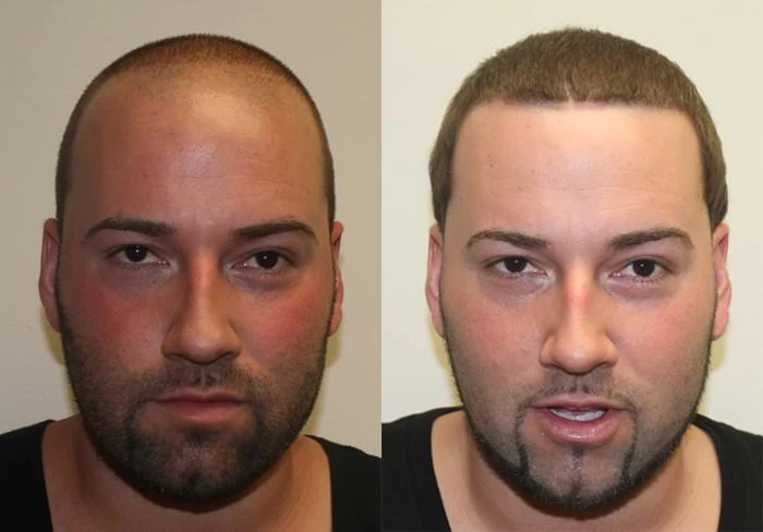 Alan Hair Transplant Before and After