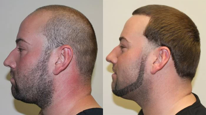 Patient p150 hair transplant before and after left view