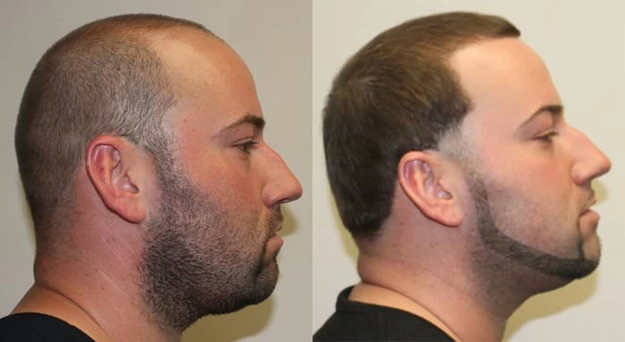 Patient p150 hair transplant before and after right view