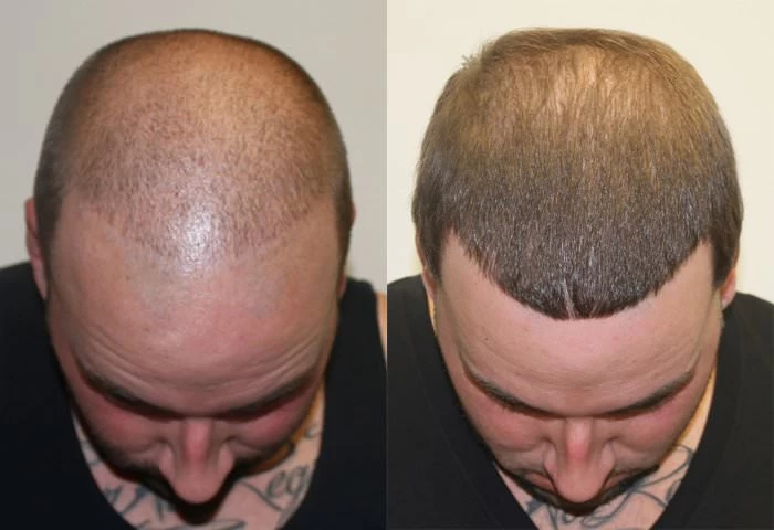 Patient p150 hair transplant before and after tilt view