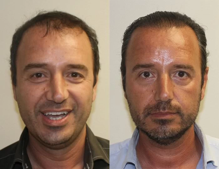 Ali Hair Transplant Before and After