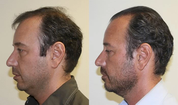 Patient p151 hair transplant before and after left view