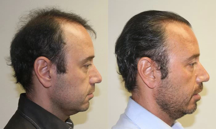Patient p151 hair transplant before and after right view