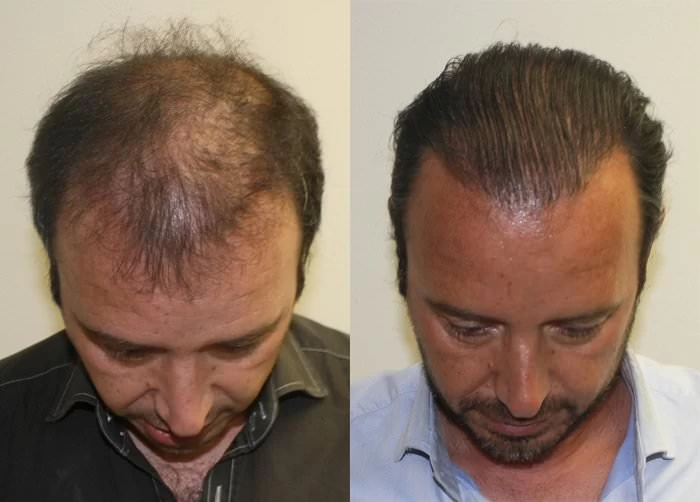 Patient p151 hair transplant before and after tilt view