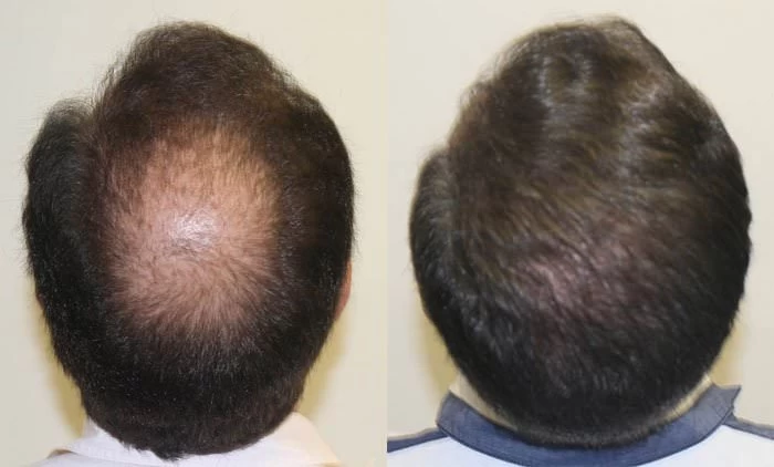 Patient p152 hair transplant before and after crown view