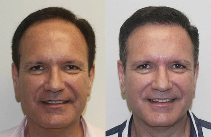 Patient 152 Hair Transplant Before and After