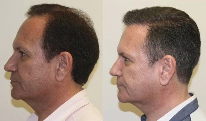 Patient p152 hair transplant before and after left view