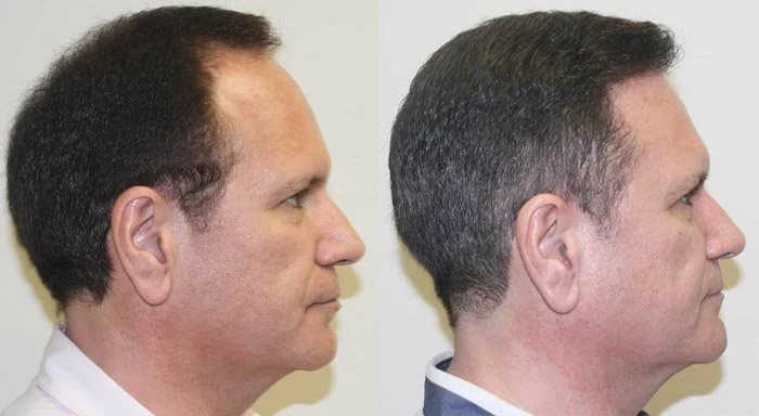 Patient p152 hair transplant before and after right view