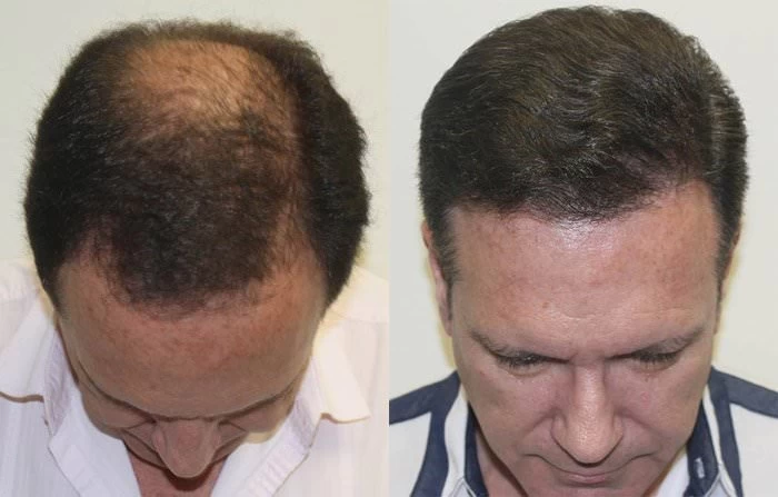 Patient p152 hair transplant before and after tilt view