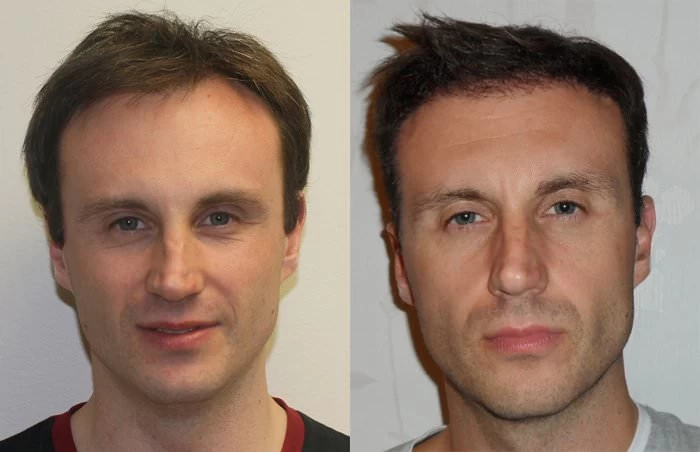 Neil  Hair Transplant Before and After